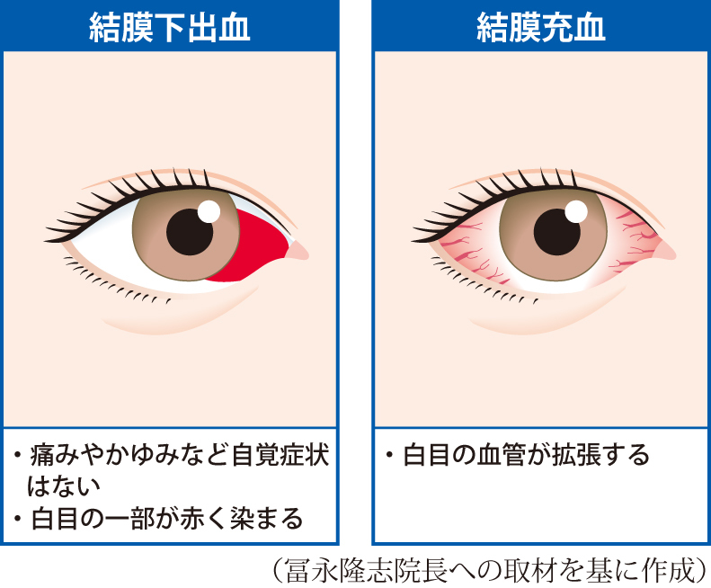 白目の一部が赤く染まる「結膜下出血」（左）と白目の血管が拡張する「結膜充血」